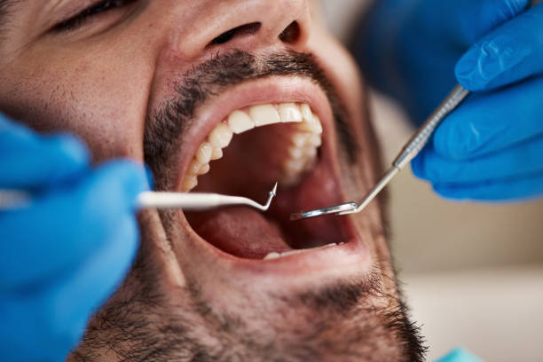 Emergency Dental Filling Replacement in SC
